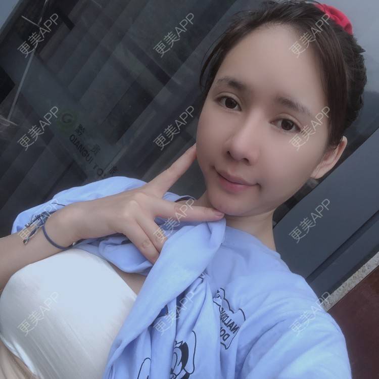 方芳纺的自体脂肪隆胸日记