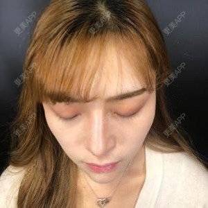 更美 - 换个新发型的鼻部多项经验 | 鼻部多项 | 合肥