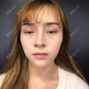 更美 - 换个新发型的鼻部多项经验 | 鼻部多项 | 合肥