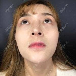 更美 - 换个新发型的鼻部多项经验 | 鼻部多项 | 合肥