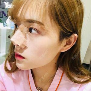 更美 - 换个新发型的鼻部多项经验 | 合肥 | 鼻部多项