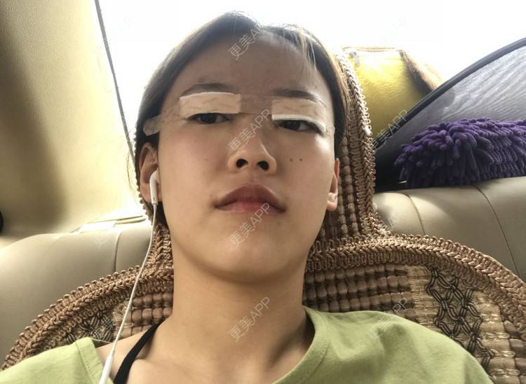 更美 - 火星你心的全切双眼皮经验 | 全切双眼皮 | 合肥