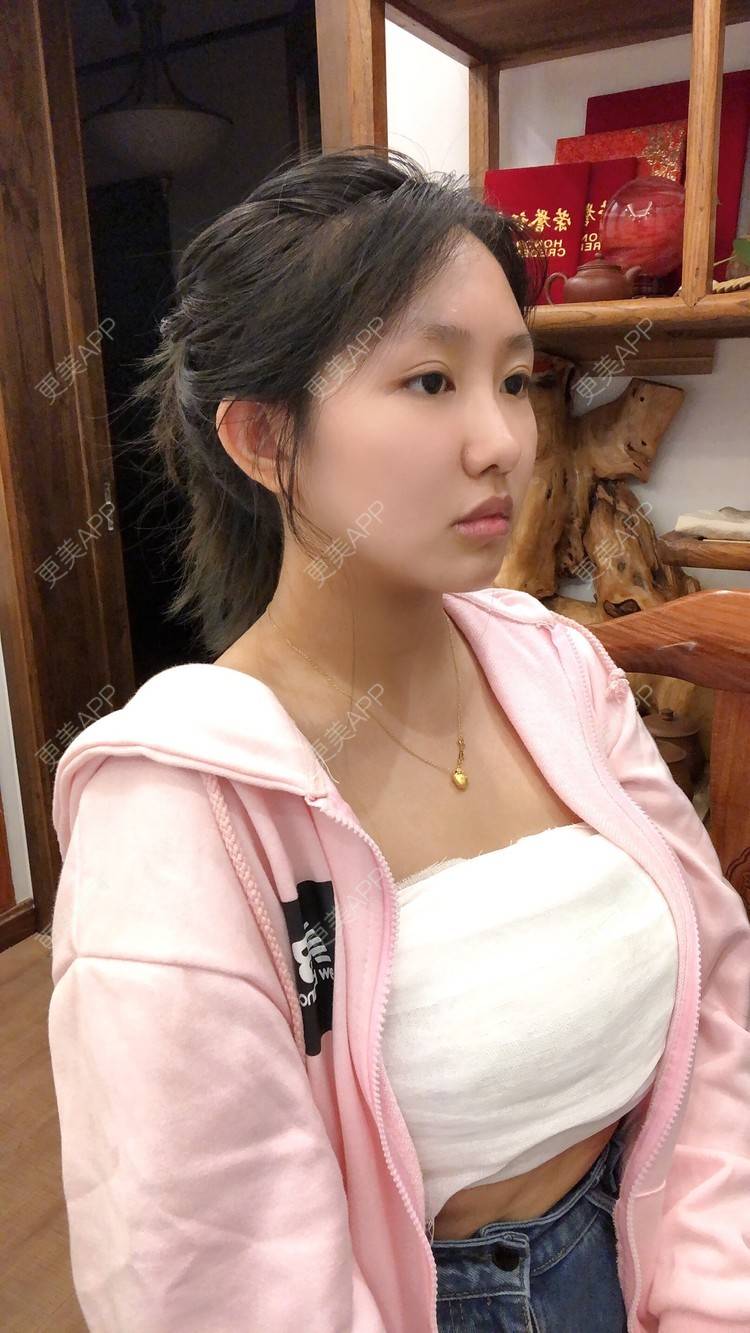 更美 - 更美用户ryq2sghmul的假体隆胸日记 | 自体脂肪隆胸 | 丰胸