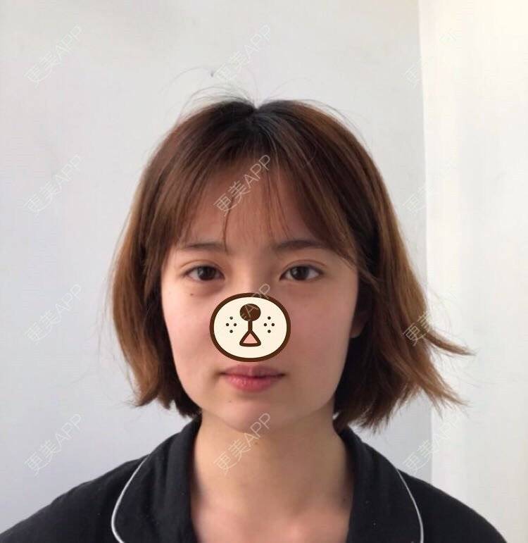 更美用户w2128yduxi的下颌角切除术日记