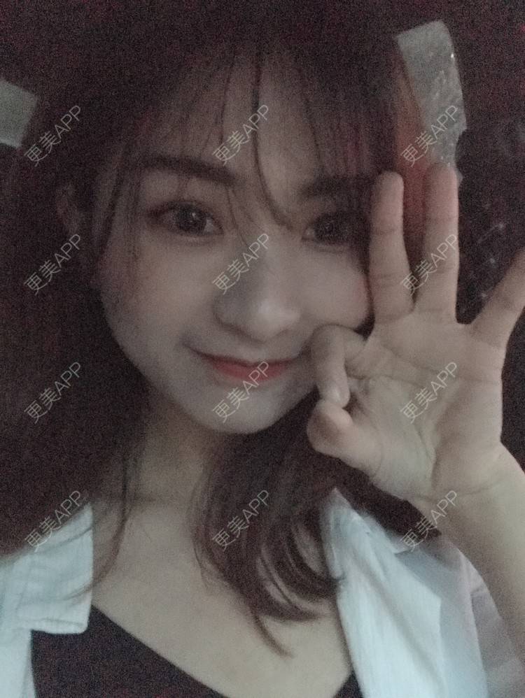 更美 - 更美用户h6811W70iO的鼻翼缩小经验 | 鼻翼缩小 | 福州 | 人工骨隆鼻 | 真皮隆鼻 | 长鼻矫正 | 微晶瓷隆鼻