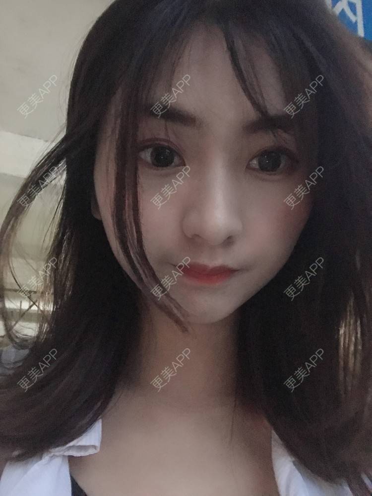 更美 - 更美用户h6811W70iO的鼻翼缩小经验 | 鼻翼缩小 | 福州 | 人工骨隆鼻 | 真皮隆鼻 | 长鼻矫正 | 微晶瓷隆鼻