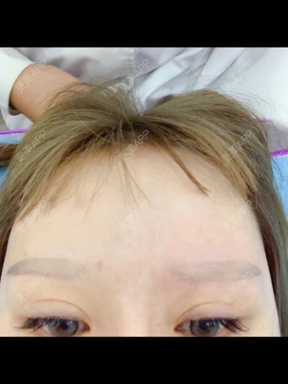 更美 - 更美用户tu1xCG1wrZ的激光洗眉经验 | 广州 | 激光洗眉 | 激光洗纹身