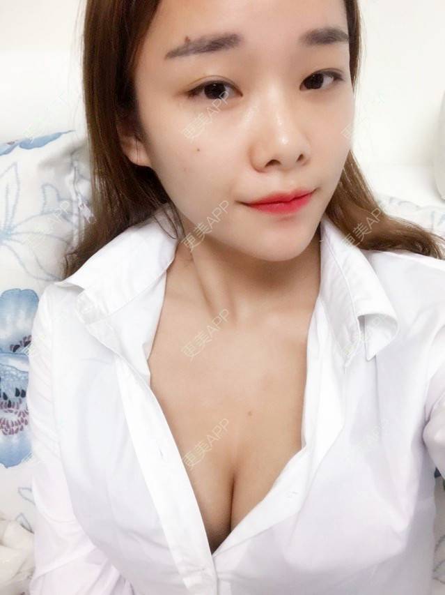 更美 - 更美用户nmgYekHkC0的假体隆胸经验 | 假体隆胸 | 胸部下垂矫正 | 美胸套餐 | 重庆