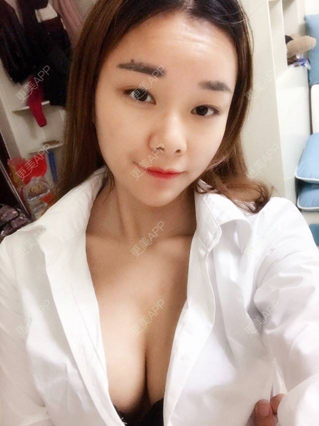 更美 - 更美用户nmgYekHkC0的假体隆胸经验 | 假体隆胸 | 胸部下垂矫正 | 美胸套餐 | 重庆