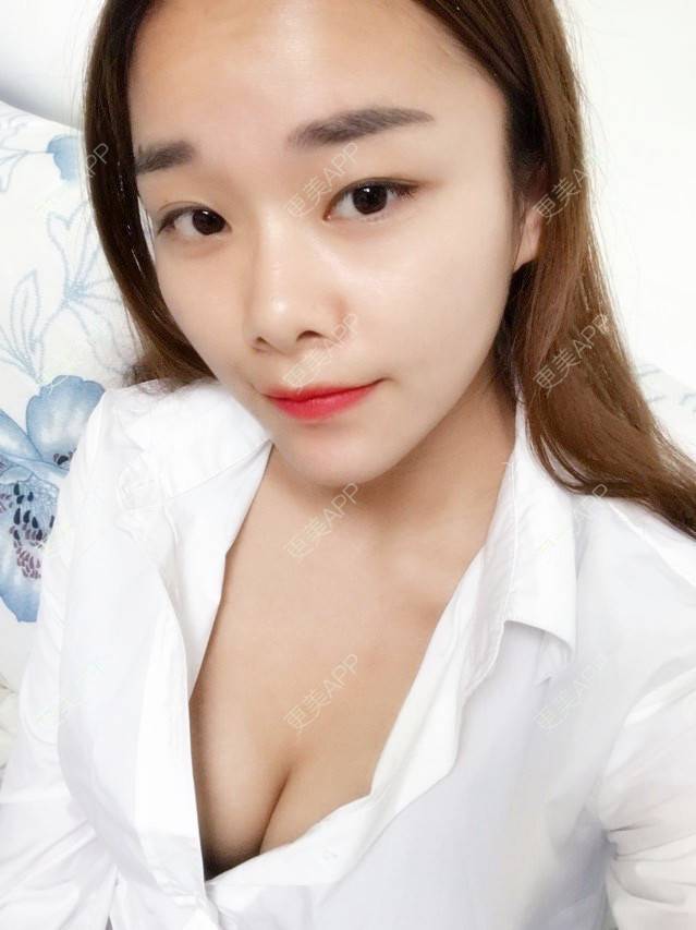 更美 - 更美用户nmgYekHkC0的假体隆胸经验 | 假体隆胸 | 胸部下垂矫正 | 美胸套餐 | 重庆