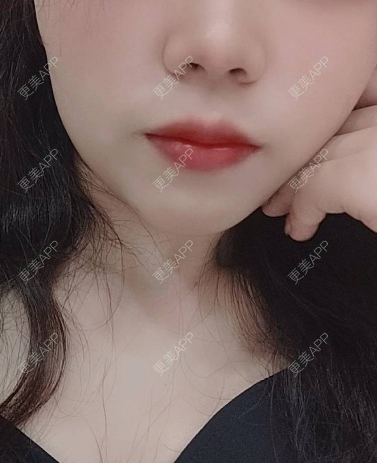 更美 - fjk吉吉的厚唇改薄经验 | 厚唇改薄 | 微笑唇手术 | 郑州