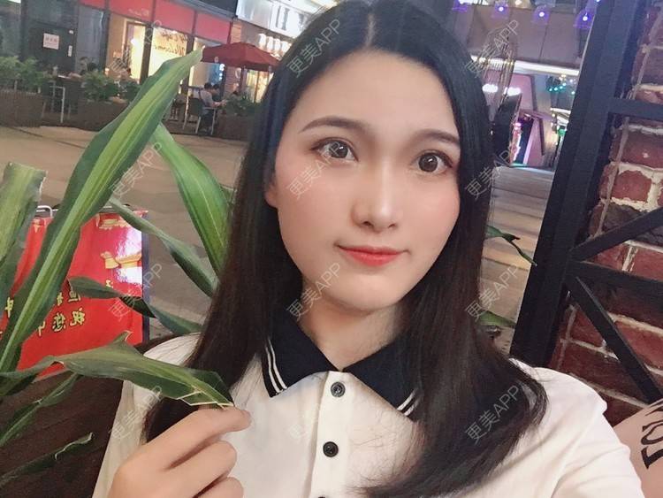 更美 - 我是小雨衣的眼部多项经验 | 开外眼角 | 视频日记 | 眼部多项 | 全切双眼皮 | 广州