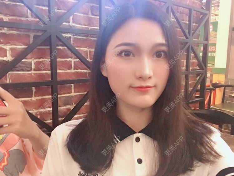 更美 - 我是小雨衣的眼部多项经验 | 开外眼角 | 视频日记 | 眼部多项 | 全切双眼皮 | 广州