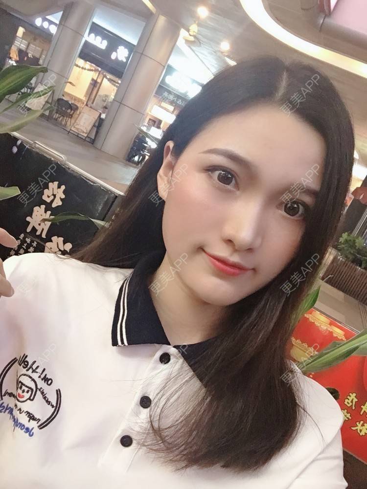 更美 - 我是小雨衣的眼部多项经验 | 开外眼角 | 视频日记 | 眼部多项 | 全切双眼皮 | 广州