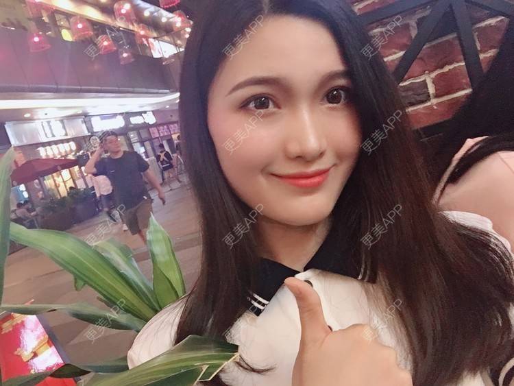 更美 - 我是小雨衣的眼部多项经验 | 开外眼角 | 视频日记 | 眼部多项 | 全切双眼皮 | 广州