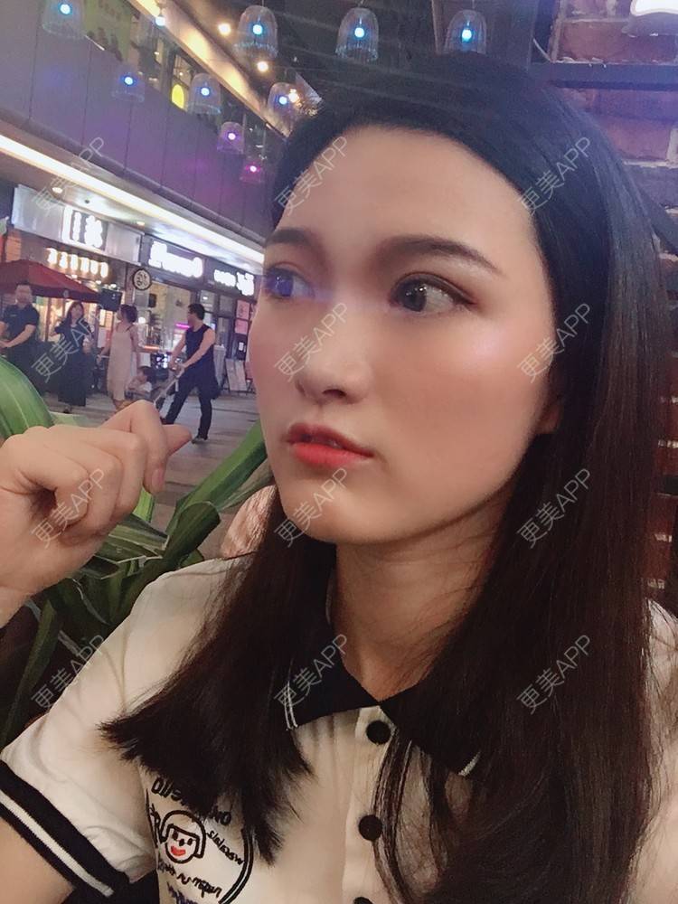 更美 - 我是小雨衣的眼部多项经验 | 开外眼角 | 视频日记 | 眼部多项 | 全切双眼皮 | 广州