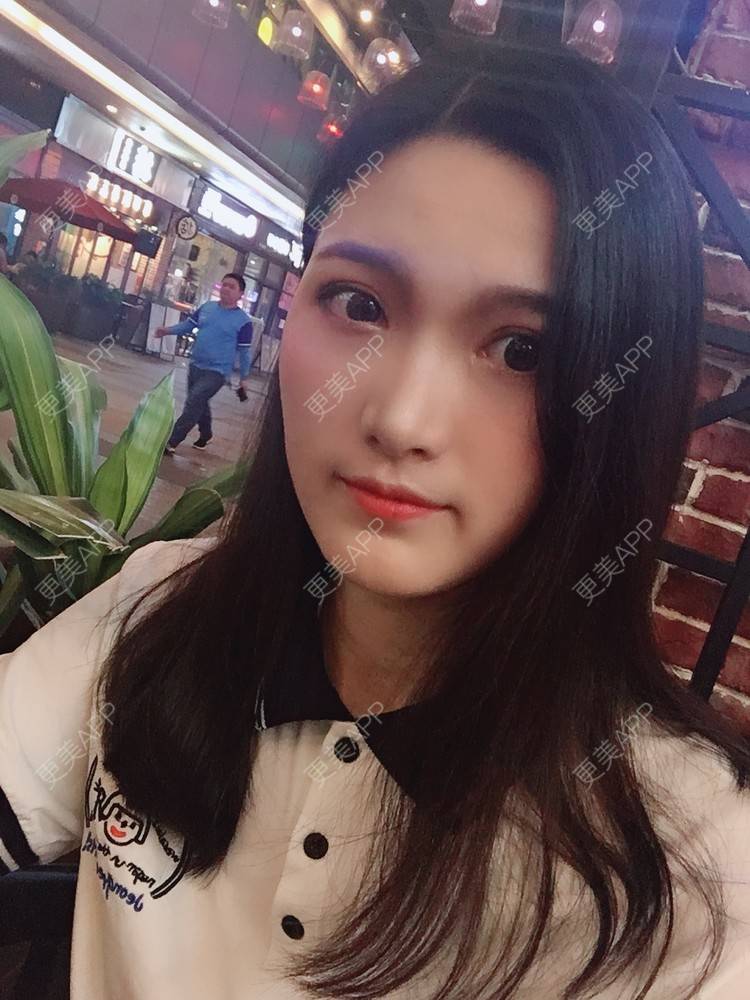 更美 - 我是小雨衣的眼部多项经验 | 开外眼角 | 视频日记 | 眼部多项 | 全切双眼皮 | 广州