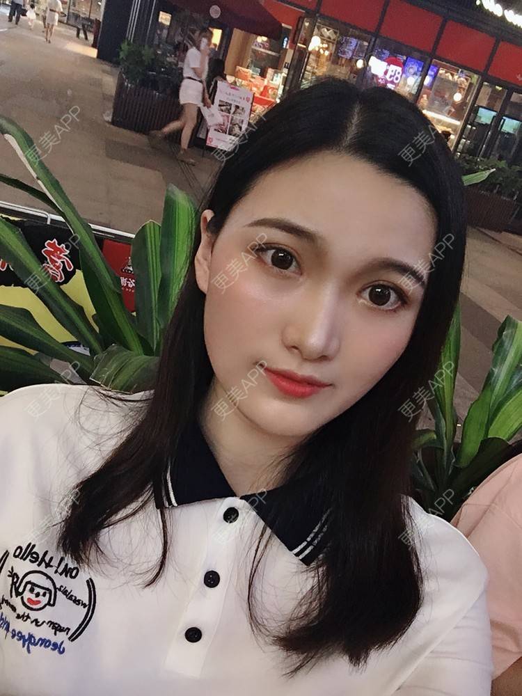 更美 - 我是小雨衣的眼部多项经验 | 开外眼角 | 视频日记 | 眼部多项 | 全切双眼皮 | 广州