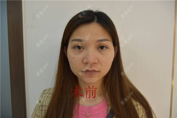 更美 - 更美用户OZwPvcZj8h的内切去眼袋经验 | 射频去眼袋 | 眶隔脂肪释放 | 激光去眼袋 | 内切去眼袋 | 北京