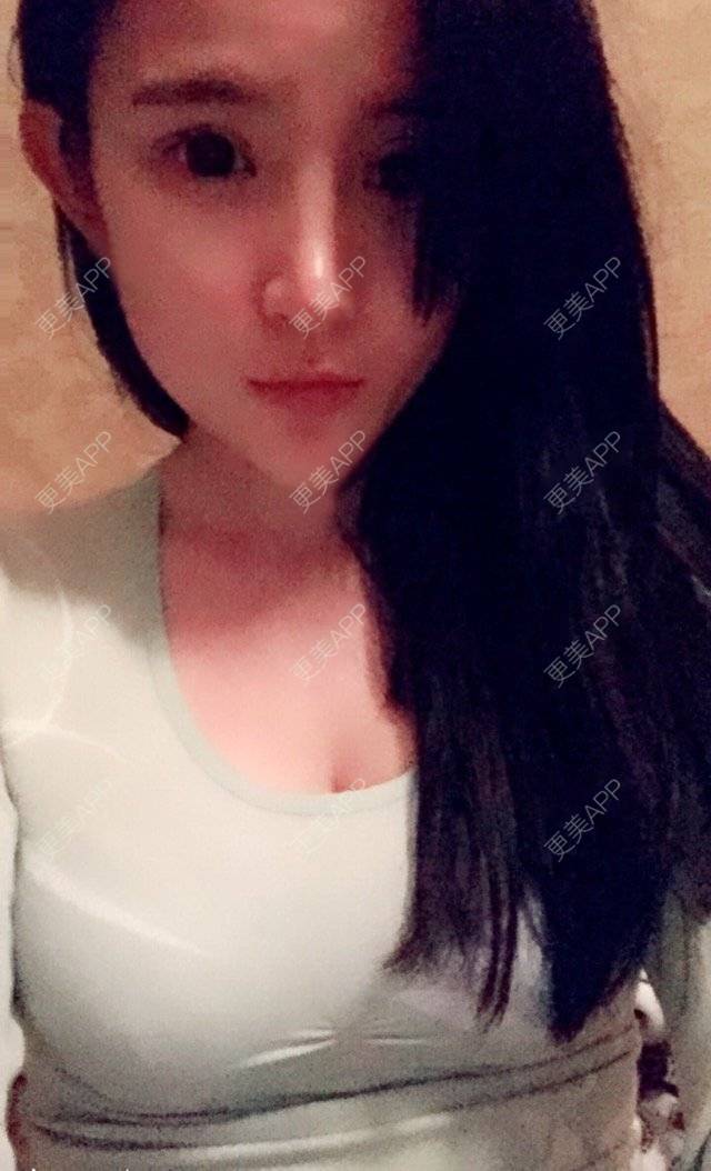 更美 - 更美用户bOtTiTFNHY的假体隆胸经验 | 假体隆胸 | 胸部下垂矫正 | 美胸套餐 | 重庆