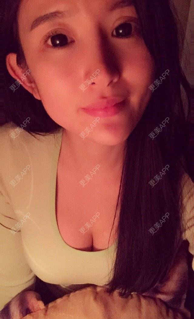 更美 - 更美用户bOtTiTFNHY的假体隆胸经验 | 假体隆胸 | 胸部下垂矫正 | 美胸套餐 | 重庆