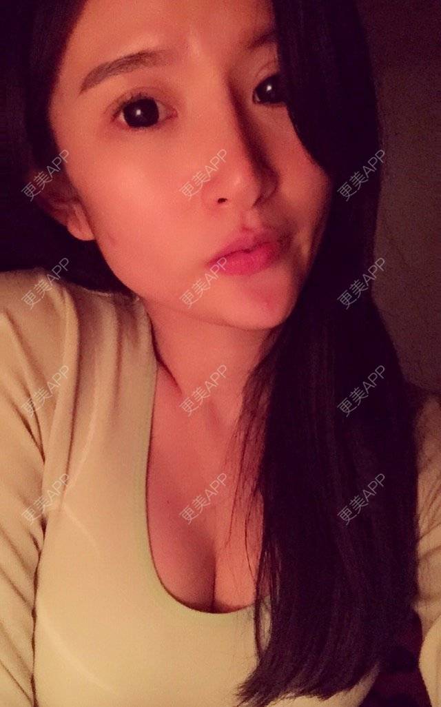 更美 - 更美用户bOtTiTFNHY的假体隆胸经验 | 假体隆胸 | 胸部下垂矫正 | 美胸套餐 | 重庆