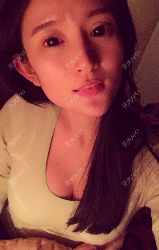 更美 - 更美用户bOtTiTFNHY的假体隆胸经验 | 假体隆胸 | 胸部下垂矫正 | 美胸套餐 | 重庆