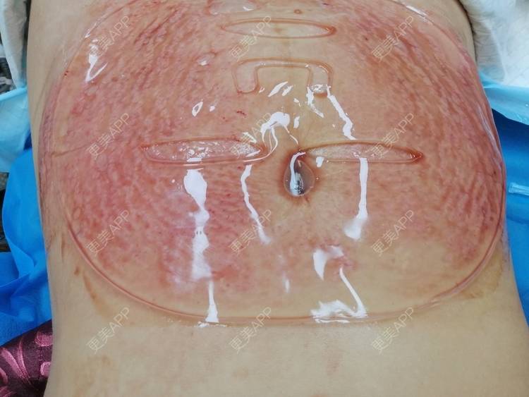 艾米妈妈的微针淡化妊娠纹日记