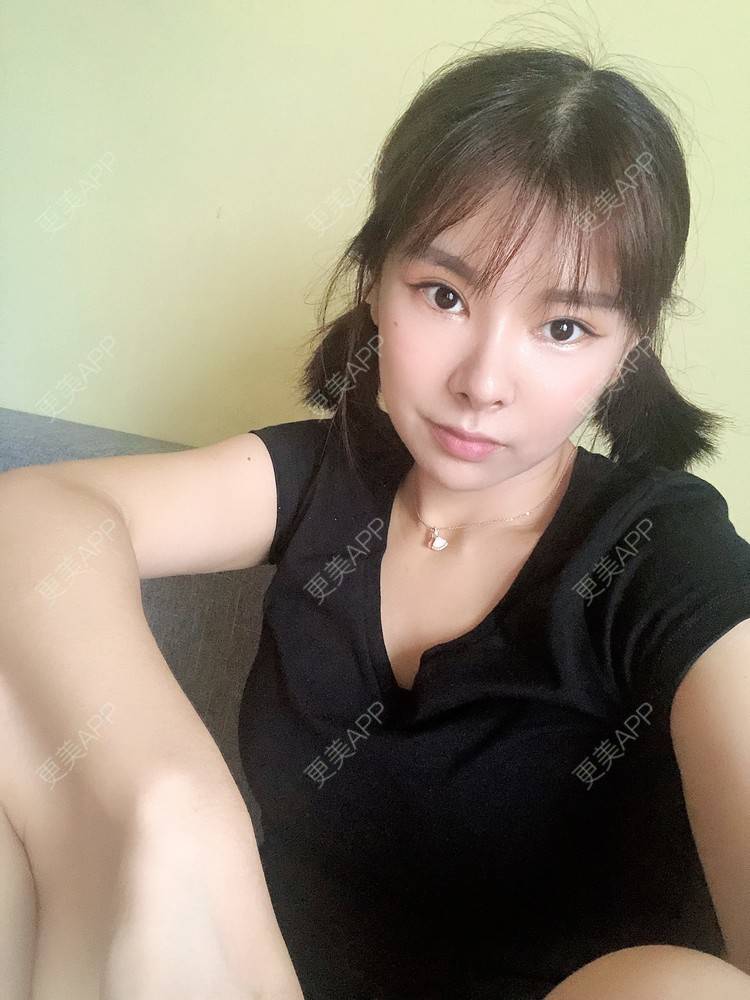 更美 - 更美用户WOuVgkC9NU的颧骨内推经验 | 颧骨内推 | 成都 | 颧弓降低