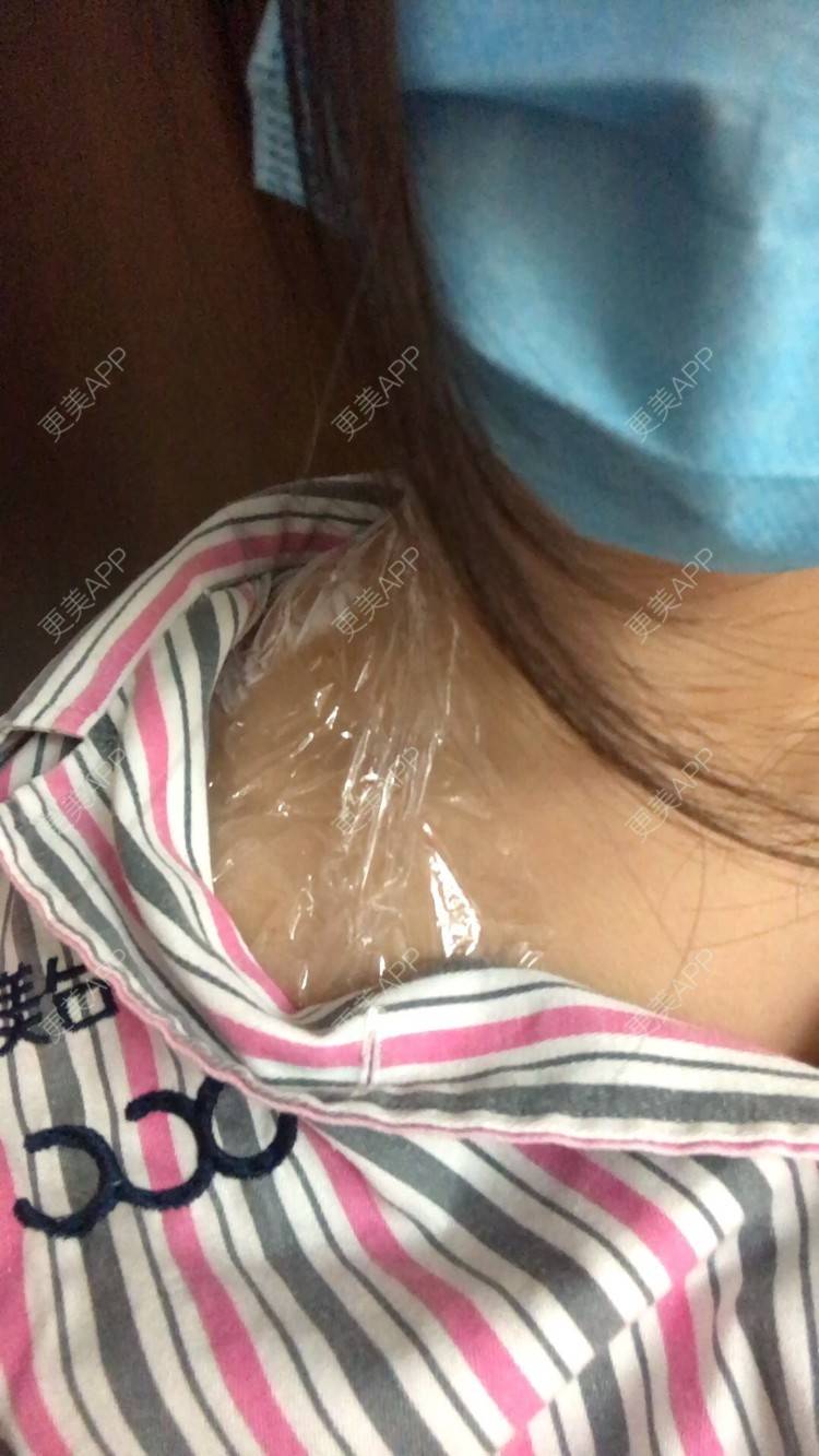 更美 - 更美用户yiAkPcjdYj的除皱瘦脸经验 | 除皱瘦脸 | 合肥 | 注射塑形肩部