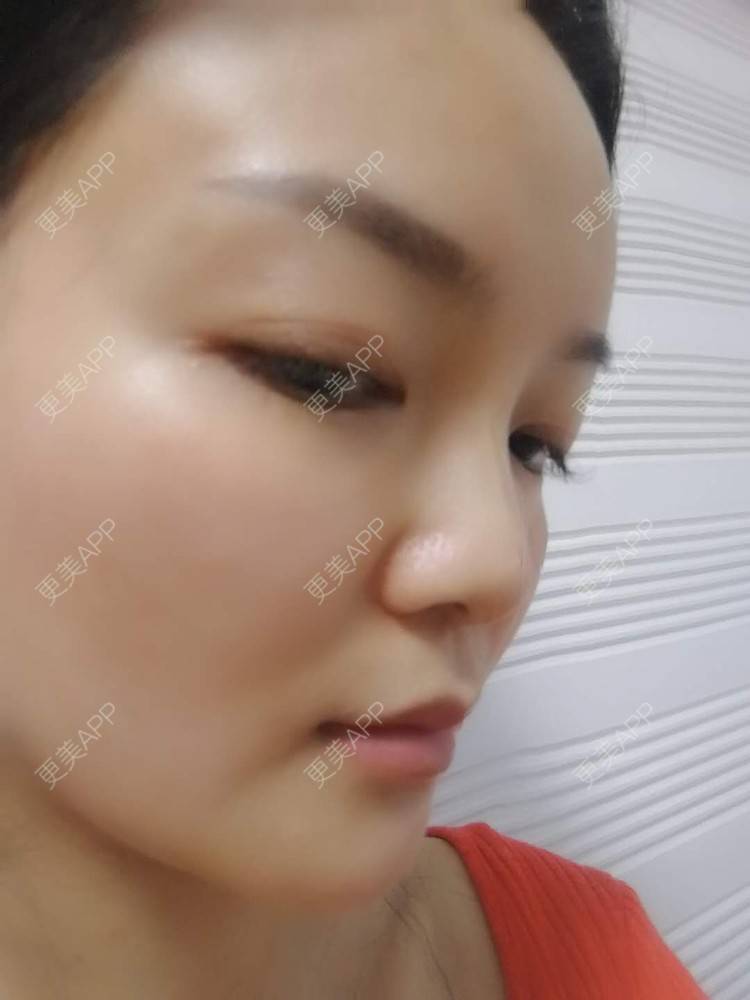 更美 - 水里的一条鱼的丰胸（隆胸）经验 | 自体脂肪隆胸 | 丰胸（隆胸） | 假体隆胸 | 胶原蛋白丰胸 | 玻尿酸隆胸