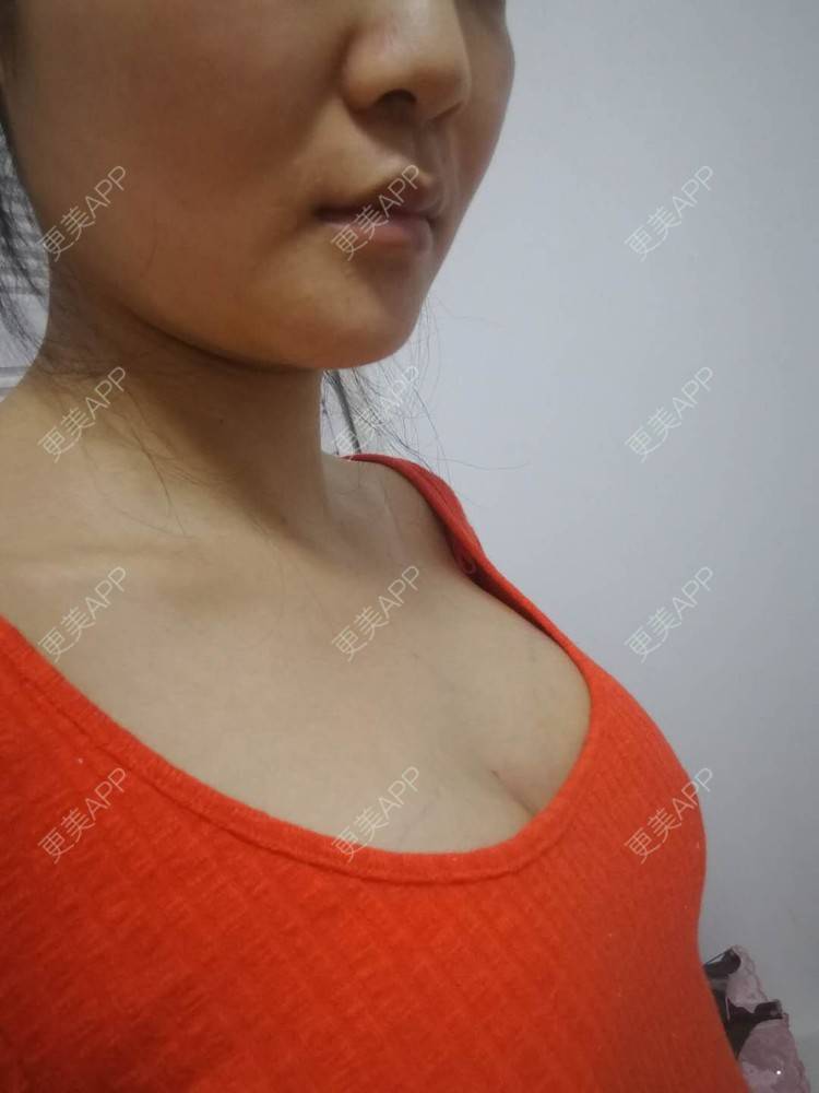 更美 - 水里的一条鱼的丰胸（隆胸）经验 | 自体脂肪隆胸 | 丰胸（隆胸） | 假体隆胸 | 胶原蛋白丰胸 | 玻尿酸隆胸