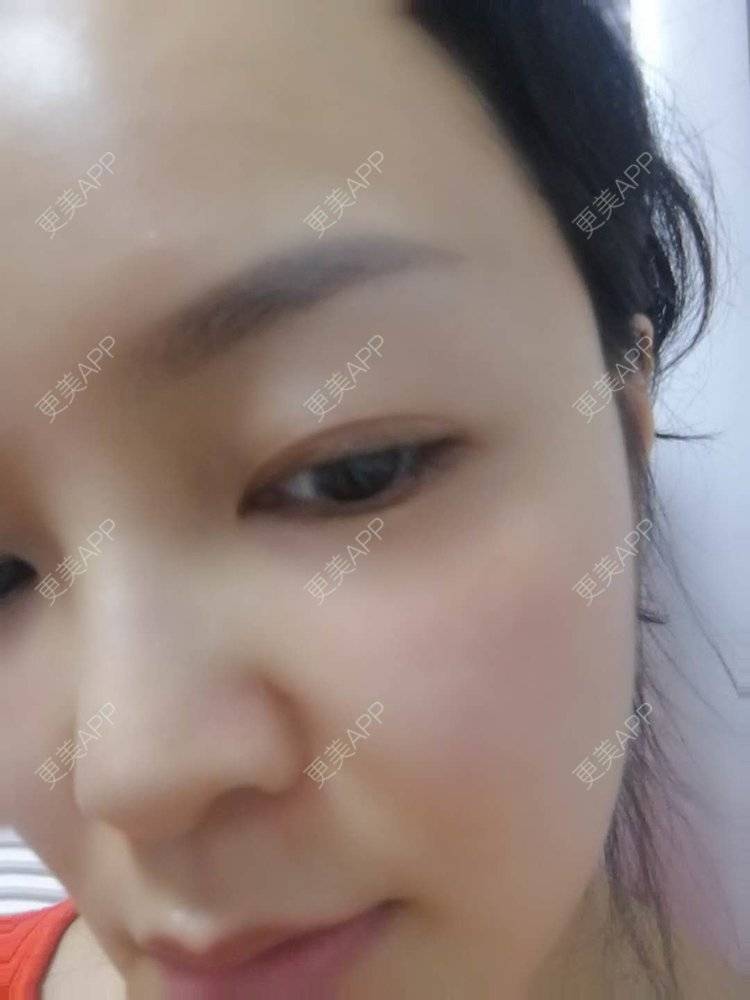 更美 - 水里的一条鱼的丰胸（隆胸）经验 | 自体脂肪隆胸 | 丰胸（隆胸） | 假体隆胸 | 胶原蛋白丰胸 | 玻尿酸隆胸