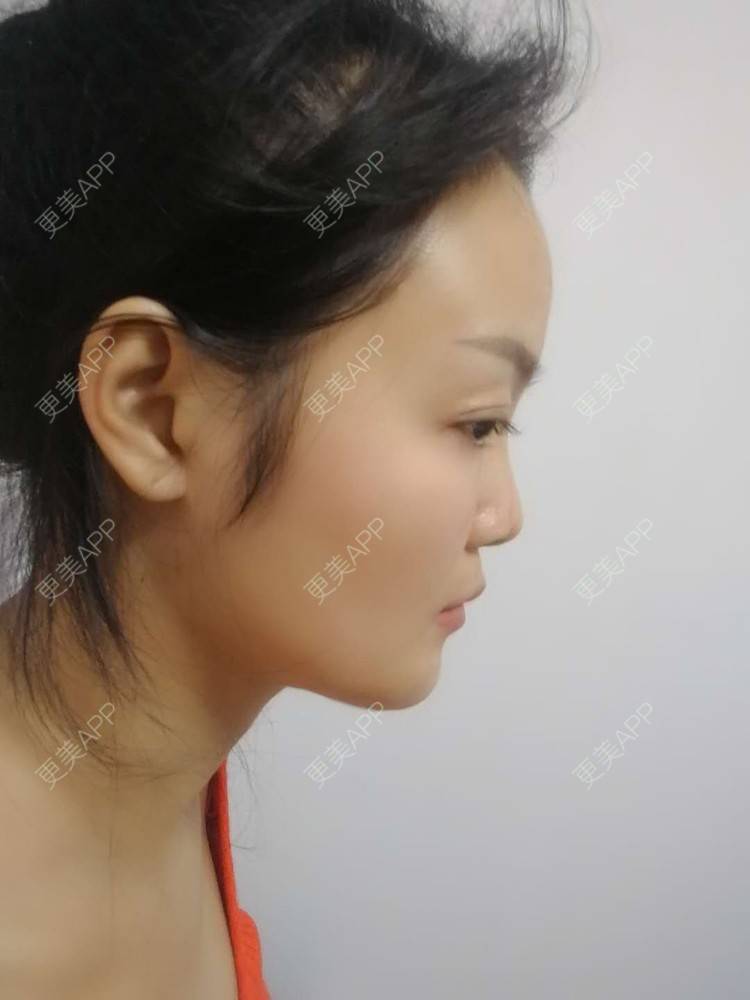 更美 - 水里的一条鱼的丰胸（隆胸）经验 | 自体脂肪隆胸 | 丰胸（隆胸） | 假体隆胸 | 胶原蛋白丰胸 | 玻尿酸隆胸