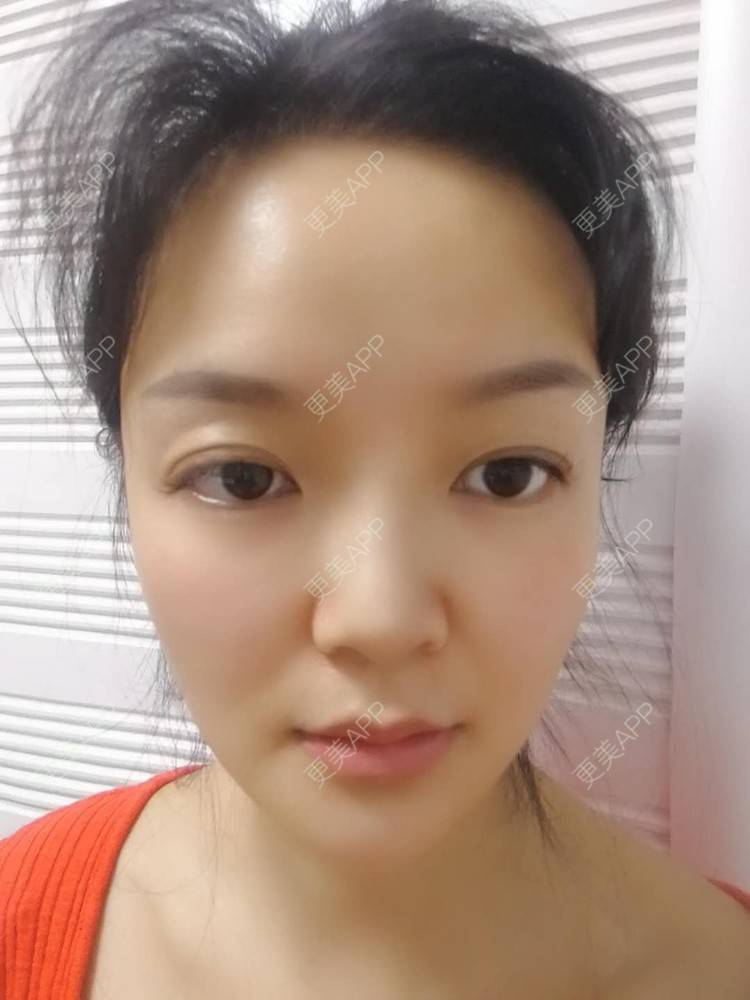 更美 - 水里的一条鱼的丰胸（隆胸）经验 | 自体脂肪隆胸 | 丰胸（隆胸） | 假体隆胸 | 胶原蛋白丰胸 | 玻尿酸隆胸