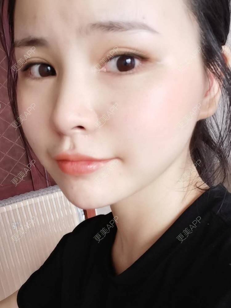 更美 - 耿直girl在线的鼻部多项经验 | 自体软骨垫鼻尖 | 垫鼻尖