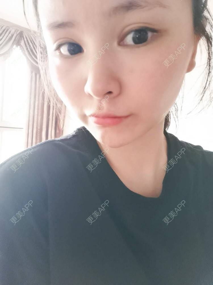 更美 - 耿直girl在线的鼻部多项经验 | 自体软骨垫鼻尖 | 垫鼻尖