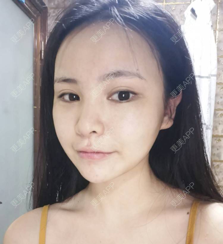 更美 - 耿直girl在线的鼻部多项经验 | 自体软骨垫鼻尖 | 垫鼻尖