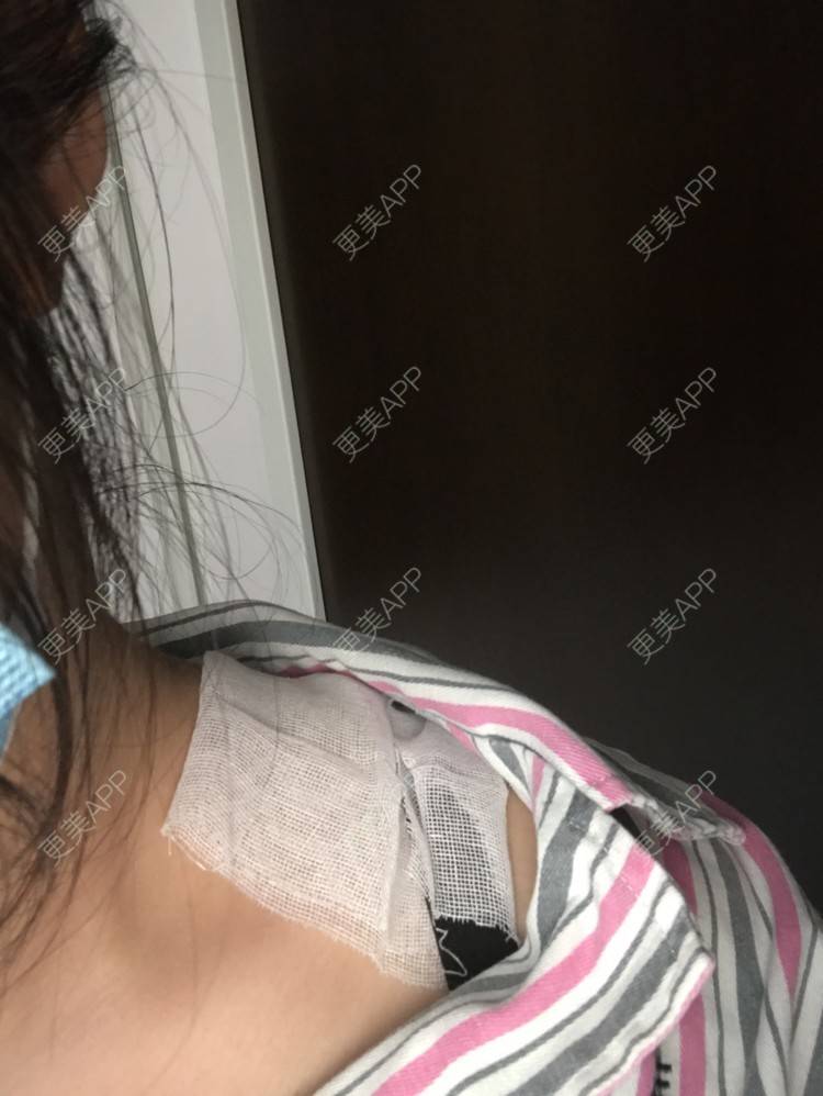 更美 - 更美用户yiAkPcjdYj的除皱瘦脸经验 | 除皱瘦脸 | 合肥 | 注射塑形肩部