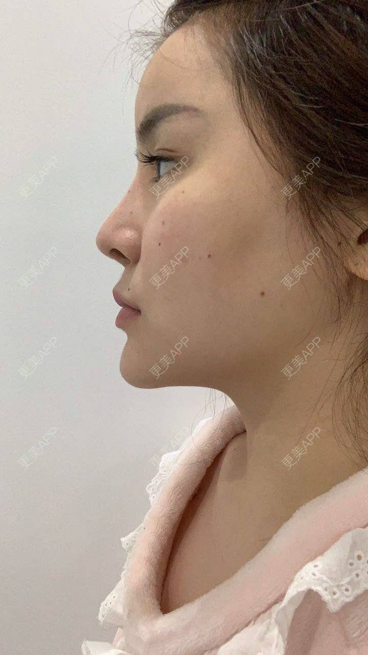 更美 - 聪明的佳琪的鼻形态修复经验 | 鼻形态修复 | 上海