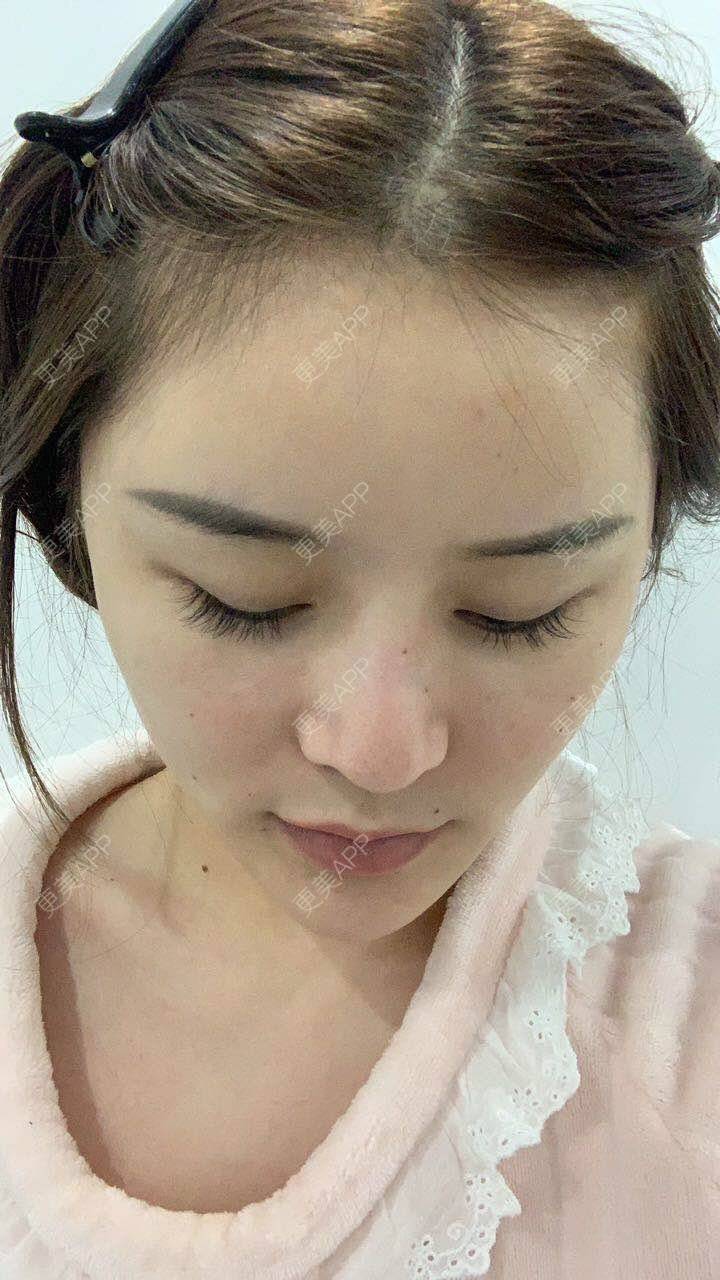 更美 - 聪明的佳琪的鼻形态修复经验 | 鼻形态修复 | 上海