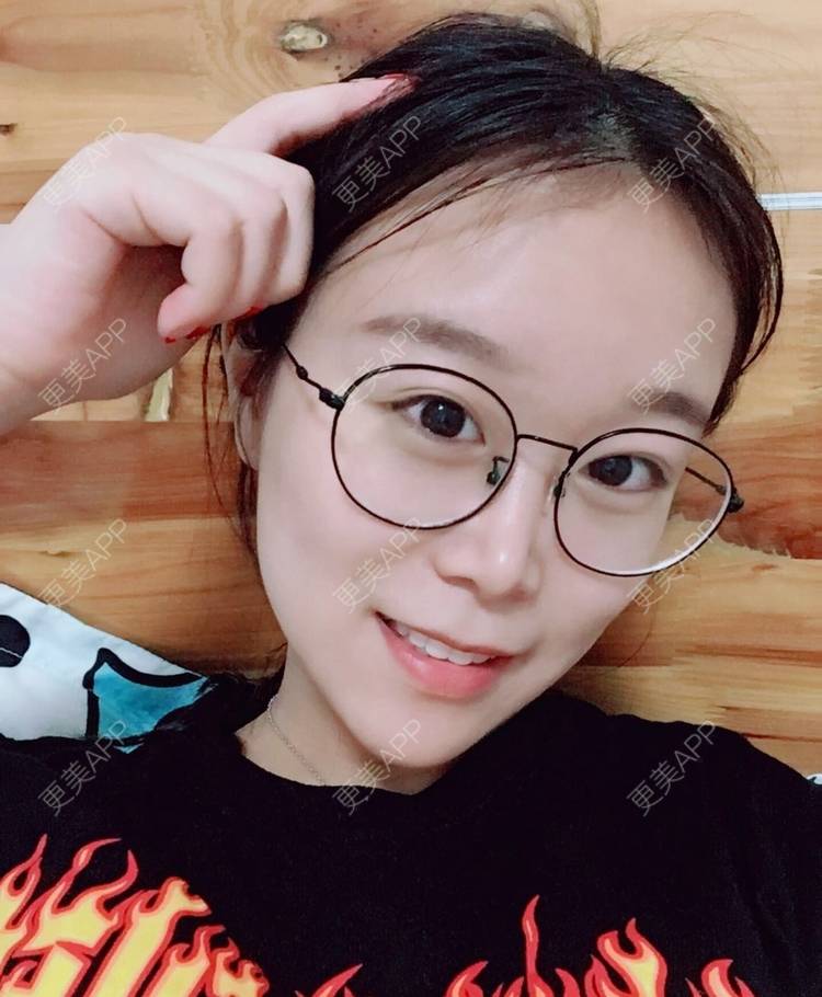 更美 - 更美用户a9vm7VkVwm的激光去眼袋经验 | 杭州 | 激光去眼袋