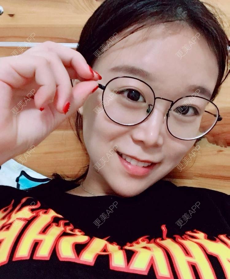 更美 - 更美用户a9vm7VkVwm的激光去眼袋经验 | 杭州 | 激光去眼袋
