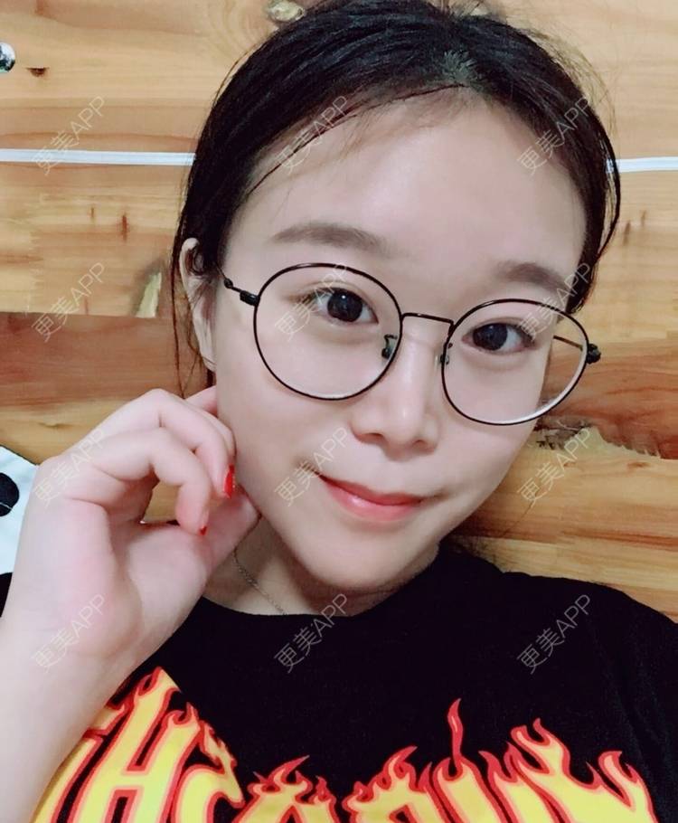 更美 - 更美用户a9vm7VkVwm的激光去眼袋经验 | 杭州 | 激光去眼袋