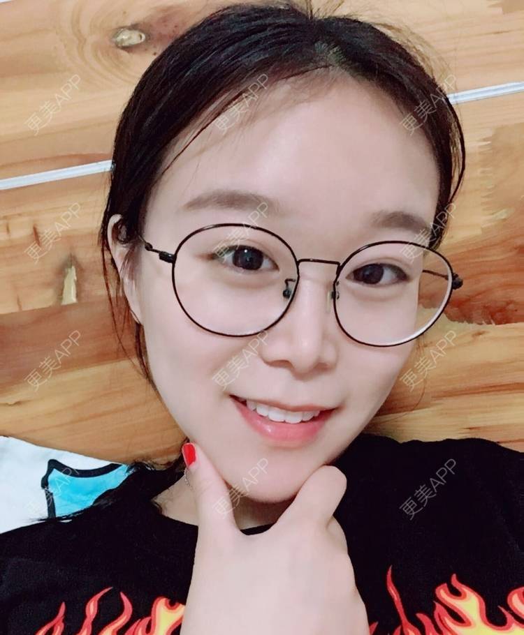 更美 - 更美用户a9vm7VkVwm的激光去眼袋经验 | 杭州 | 激光去眼袋