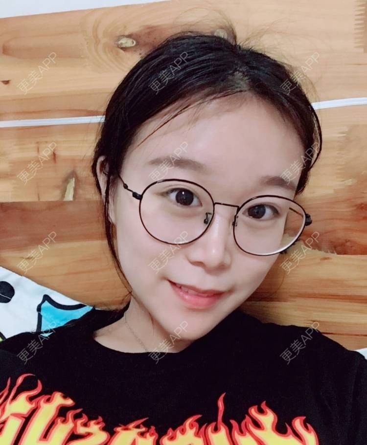 更美 - 更美用户a9vm7VkVwm的激光去眼袋经验 | 杭州 | 激光去眼袋