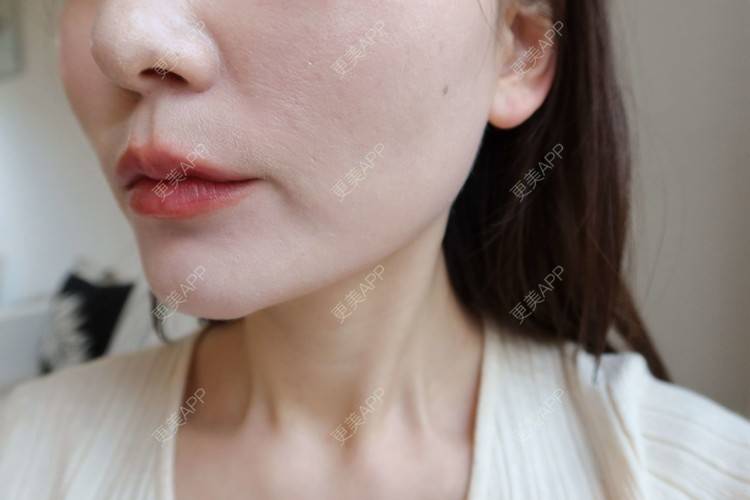 更美 - 更美用户GLhBqITBzy的热玛吉经验 | 成都 | 热玛吉