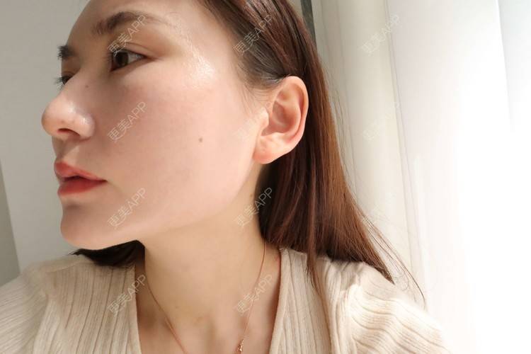 更美 - 更美用户GLhBqITBzy的热玛吉经验 | 成都 | 热玛吉
