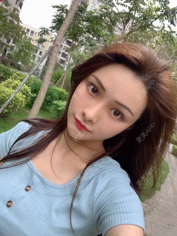 更美 - 假装很正经的自体脂肪丰苹果肌经验 | 自体脂肪填充泪沟 | 视频日记 | 自体脂肪丰苹果肌 | 广州