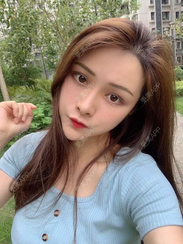 更美 - 假装很正经的自体脂肪丰苹果肌经验 | 自体脂肪填充泪沟 | 视频日记 | 自体脂肪丰苹果肌 | 广州